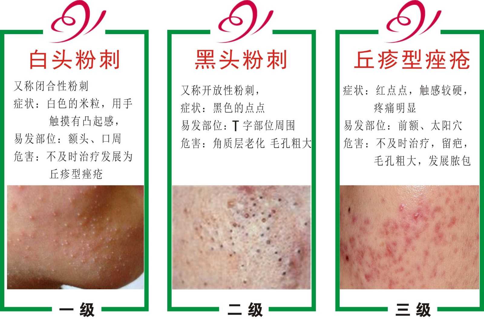 白头粉刺和黑头粉刺的区别 脸上长白头粉刺怎么去除