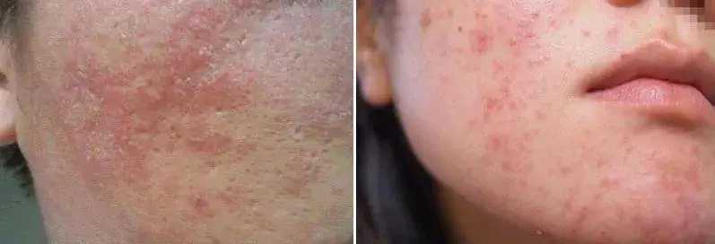 对精华过敏是什么样的?精华液过敏怎么处理 对精华过敏是什么样的?精华液过敏怎么处理