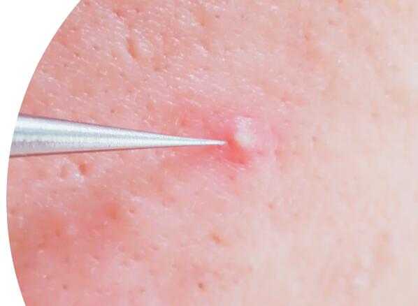 粉刺针怎么去黑头？