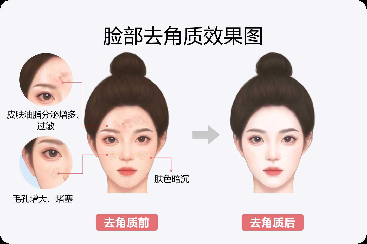 女人脸部长期不去角质会怎样