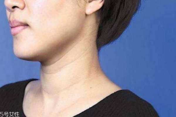 很年轻为什么就有颈纹