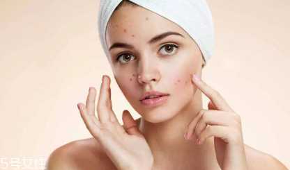 顽固痘痘怎么消除？油皮为什么反复爆痘？