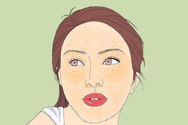 黄瓜和白可以去除黄褐斑吗