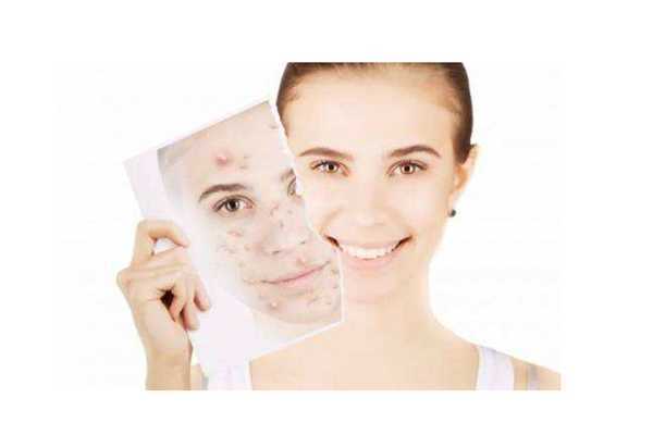 粉刺会不会越挤越多 粉刺会不会越挤越多