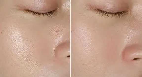 角质层薄可以用去黑头产品吗? 角质层薄可以用去黑头产品吗?