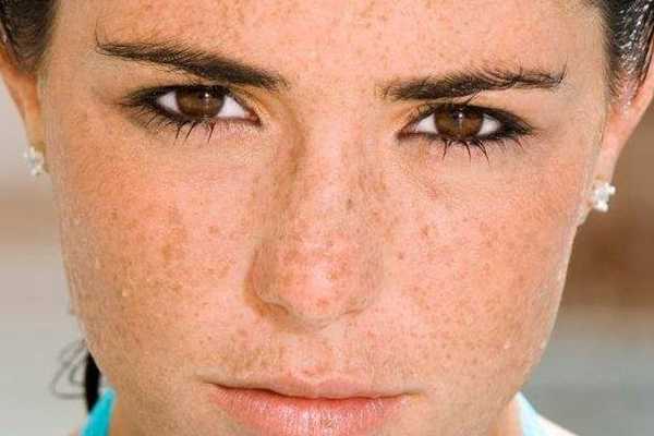 色斑咋去掉 色斑咋去掉