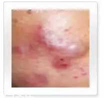 平衡露什么成分能祛痘