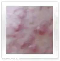 平衡露什么成分能祛痘