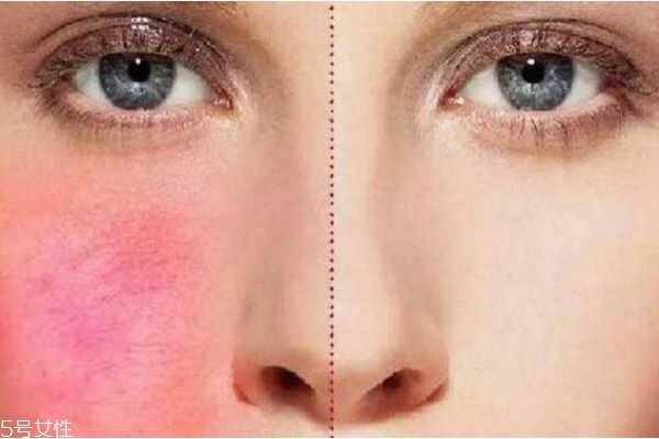 红血丝该如何治疗