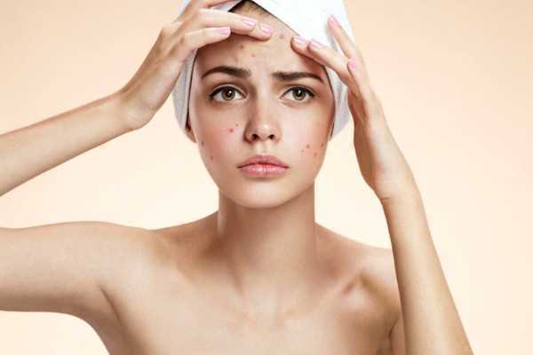 粉刺会不会越挤越多 粉刺会不会越挤越多