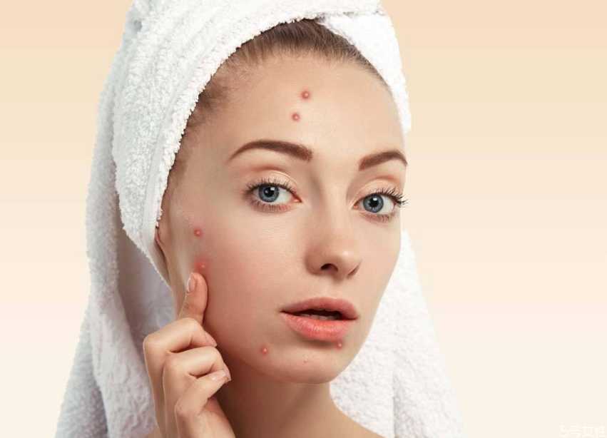 戴口罩下巴长痘痘怎么办？怎样避免戴口罩闷痘