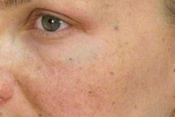 色素沉着能祛除吗？色素沉着怎么快速去除