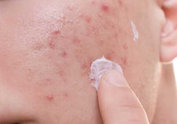 狮王祛痘膏怎么用 狮王祛痘膏怎么用