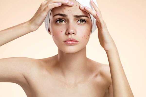 上海硫磺皂可以祛痘吗 上海硫磺皂可以祛痘吗