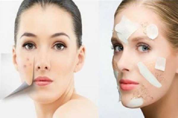 去黑头是鼻贴好还是泥膜好