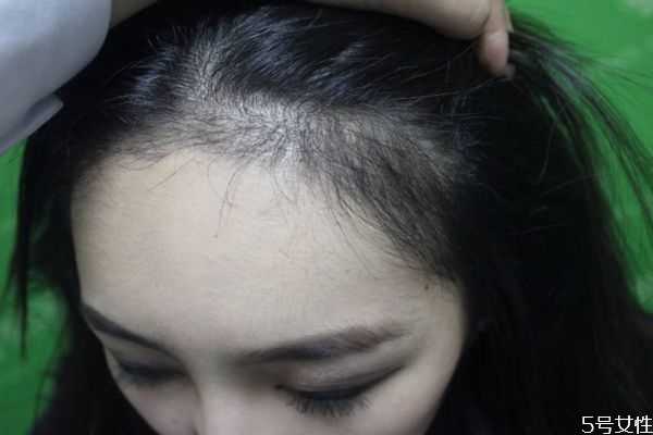 修容棒可以修发际线吗 如何修饰发际线