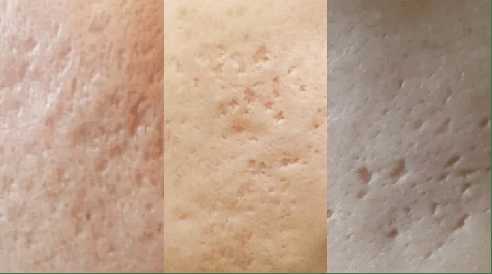 痘印痘坑难消除？这个方法强烈建议你试试