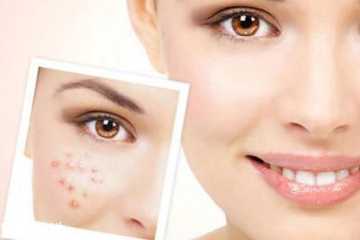 长痘痘用什么精油好