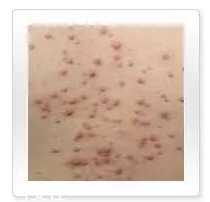 平衡露什么成分能祛痘