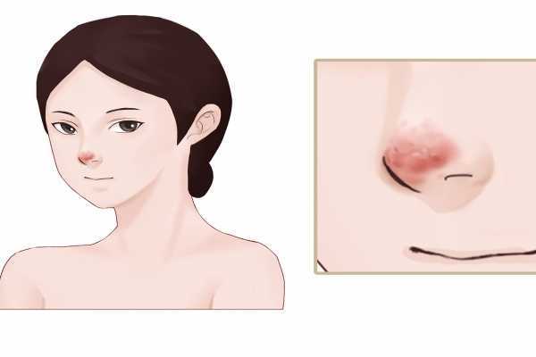 鼻子黑头是怎么回事 鼻子黑头是怎么回事