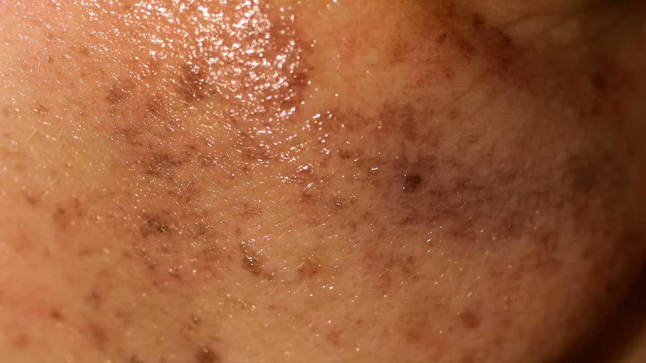 角质层薄能做面部拨筋吗?面部拨筋的方法是什么? 角质层薄能做面部拨筋吗?面部拨筋的方法是什么?