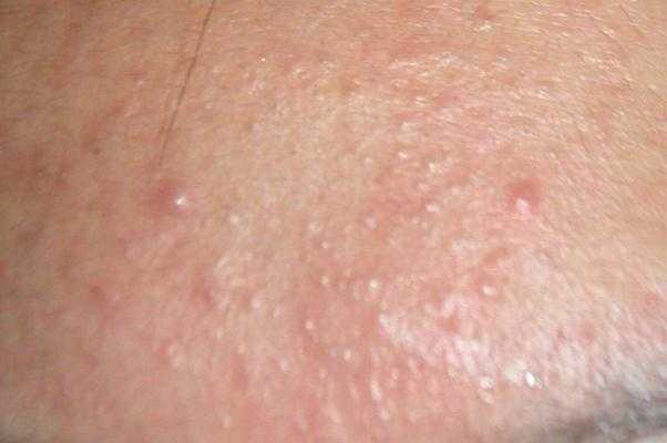 粉刺有硬块但是挤不出来怎么办