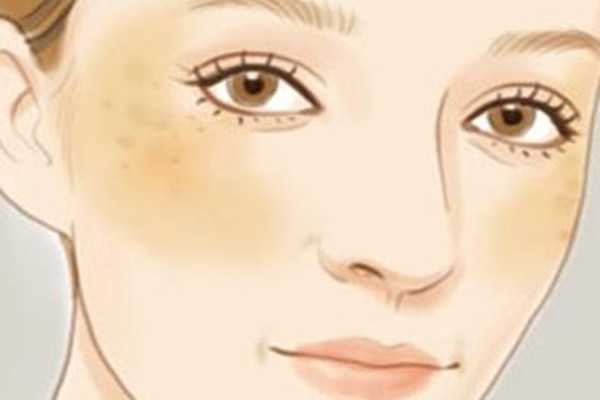 黄褐斑会不会遗传?黄褐斑会不会越长越多 黄褐斑会不会遗传?黄褐斑会不会越长越多