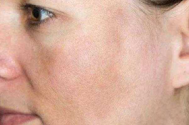 色素沉着能祛除吗？色素沉着怎么快速去除