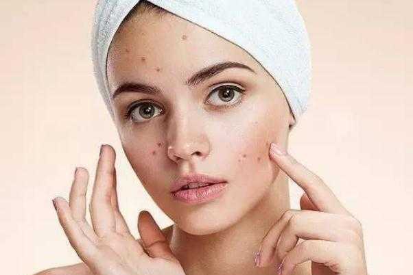 粉刺有硬块但是挤不出来怎么办