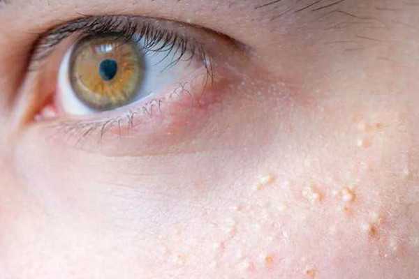 脂肪粒能用针挑掉吗 脂肪粒能用针挑掉吗