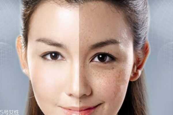怎么去除脸上的斑