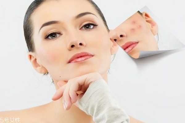 痘痘肌适合用什么护肤品 痘痘肌适合用什么护肤品