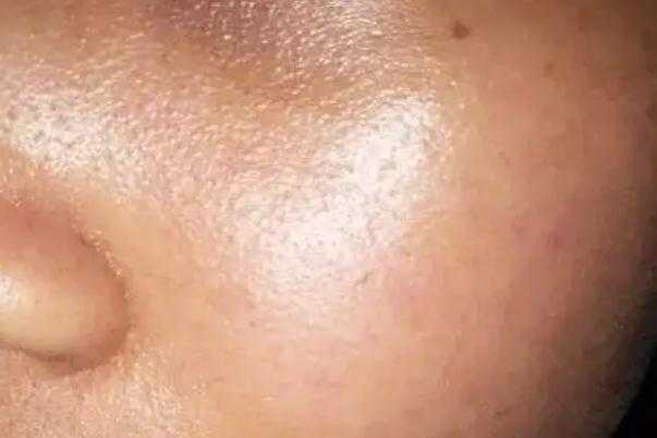 皮肤出油多是什么原因 皮肤出油严重毛孔粗大如何改善