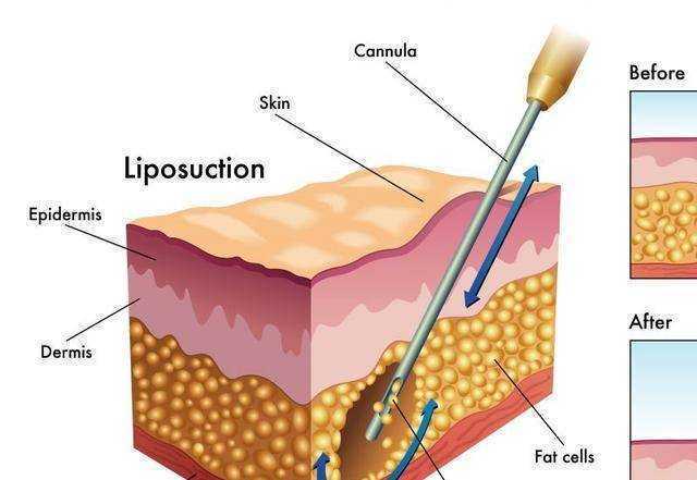 抽脂手术的伤害有多大? 抽脂手术的伤害有多大?