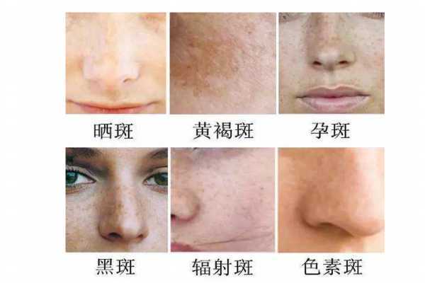 孕斑长什么样子