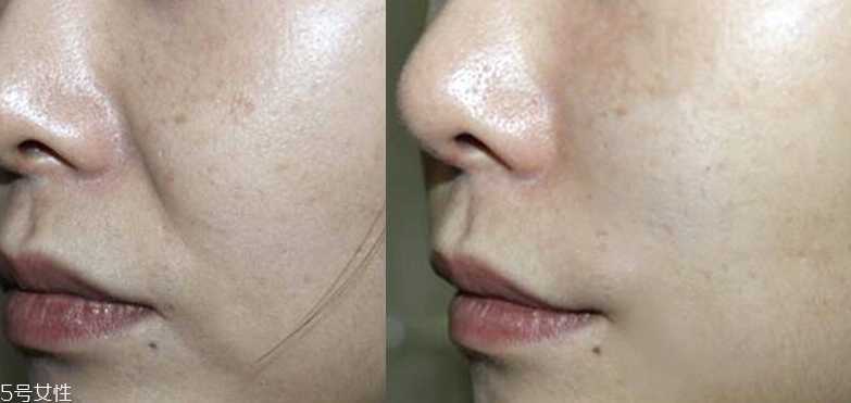 微针眼膜能天天使用吗 一个礼拜用一次