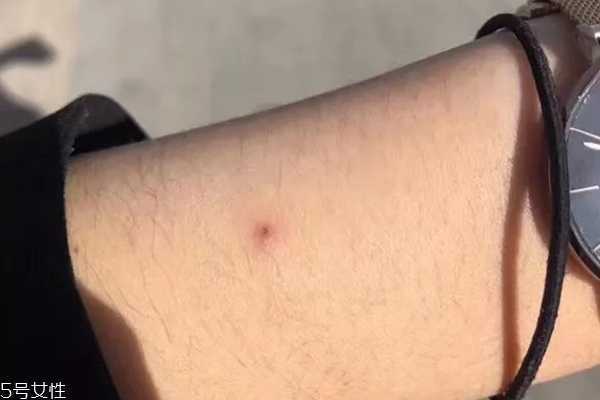 悦木之源祛痘凝胶刺痛什么原因