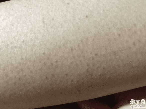 擦身体乳能不能去鸡皮?女生如何祛除身上的鸡皮 擦身体乳能不能去鸡皮?女生如何祛除身上的鸡皮