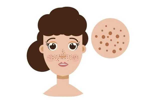 黄褐斑属于真皮斑吗？黄褐斑跟真皮斑的区别