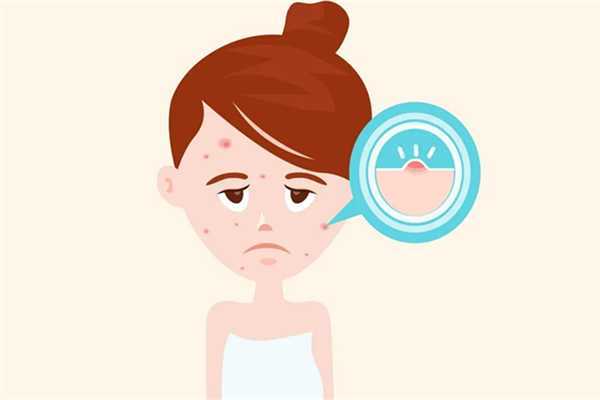 夏季脸上出油长痘怎么办?夏季皮肤出油严重怎么办 夏季脸上出油长痘怎么办?夏季皮肤出油严重怎么办