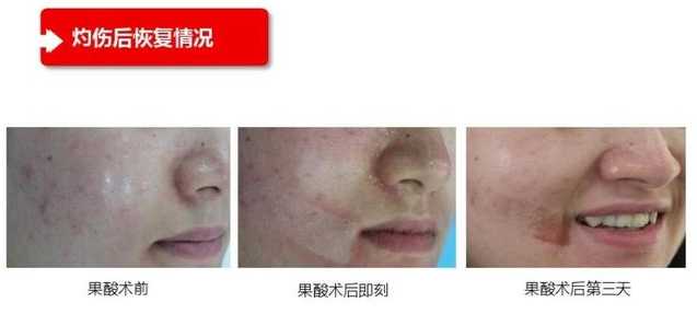 甘醇酸60可以刷脸吗？在家用甘醇酸刷酸教程