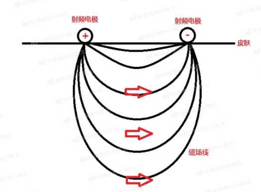 射频美容仪原理是什么