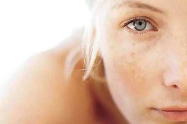 晒斑可以自然消失吗？晒斑可以用激光去掉吗