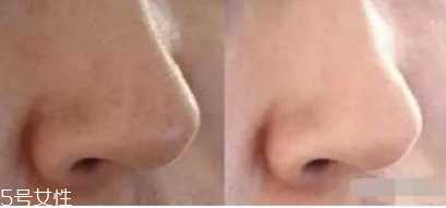 痘痘肌怎么调理