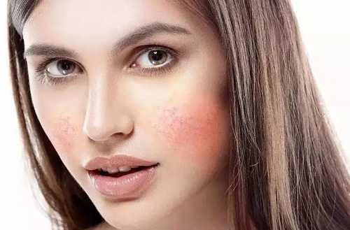 冬天脸上有红血丝怎么办? 冬天脸上有红血丝怎么办?