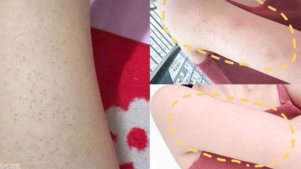 毛孔角化症怎么治 毛孔角化症怎么治