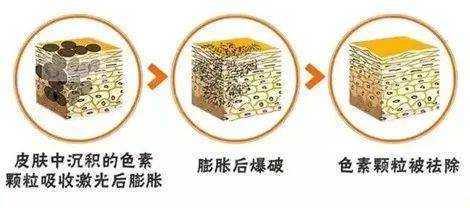 超皮秒祛斑做一次就有效果吗