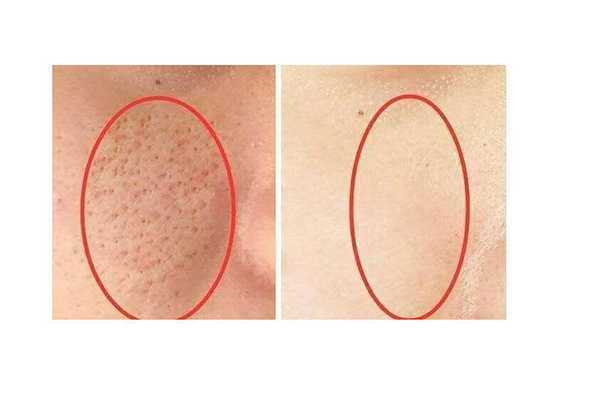 激光收缩毛孔手术原理 激光收缩毛孔手术原理