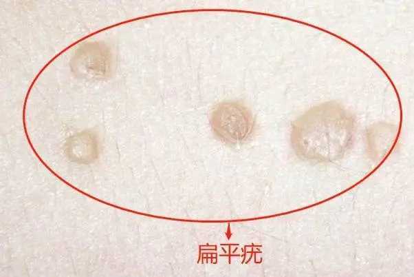 感染hpv的痘痘长啥样(附图) 感染hpv的痘痘长啥样(附图)