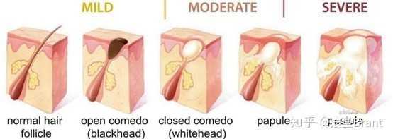 薰衣草精油可以直接涂在脸上吗 薰衣草精油可以直接涂在脸上吗
